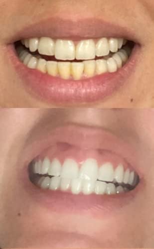 חיוך ערכת הלבנת שיניים של טיטאן, ג'ל הלבנת שיניים עם מאיץ LED 5x אור ומלבש שיניים מגש