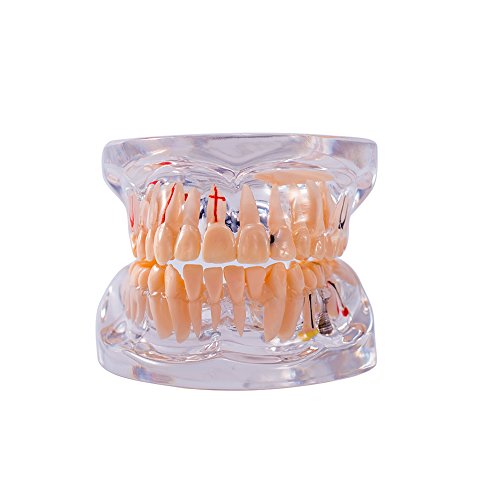 מודל פתולוגיה של שיניים עם שיניים עם השתל ומחלות שיניים שקופות שות
